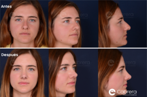 5782C-300x199 Tipos de rinoplastia | Abierta, cerrada y de revisión | Dr. Emilio Cabrera