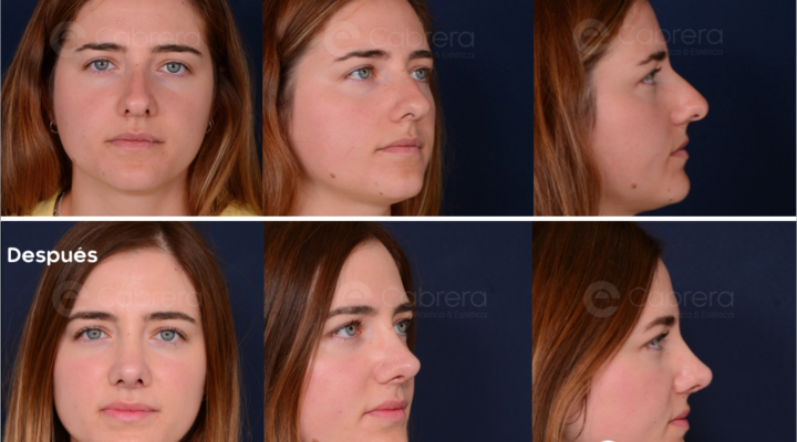 5782C-720x400 Noticias cirugía facial