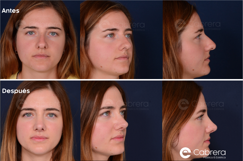 5782C Antes y después en rinoplastia