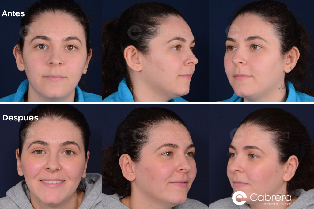 8756C-copia-3 Antes y después en otoplastia