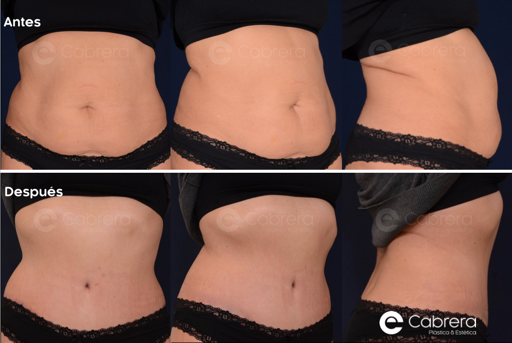 8776C Antes y después en abdominoplastia