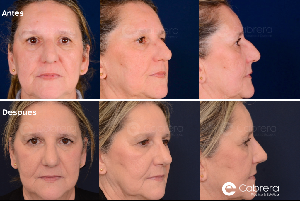 8819C Antes y después en rinoplastia