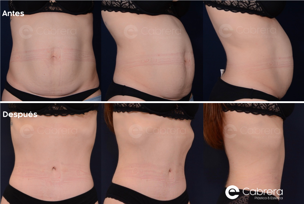 8838C Antes y después en abdominoplastia