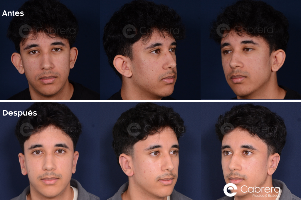 9025C-copia-2-1 Antes y después en otoplastia