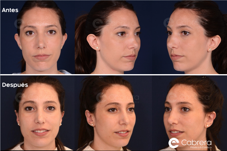 9104C-copia-2-1 Antes y después en otoplastia