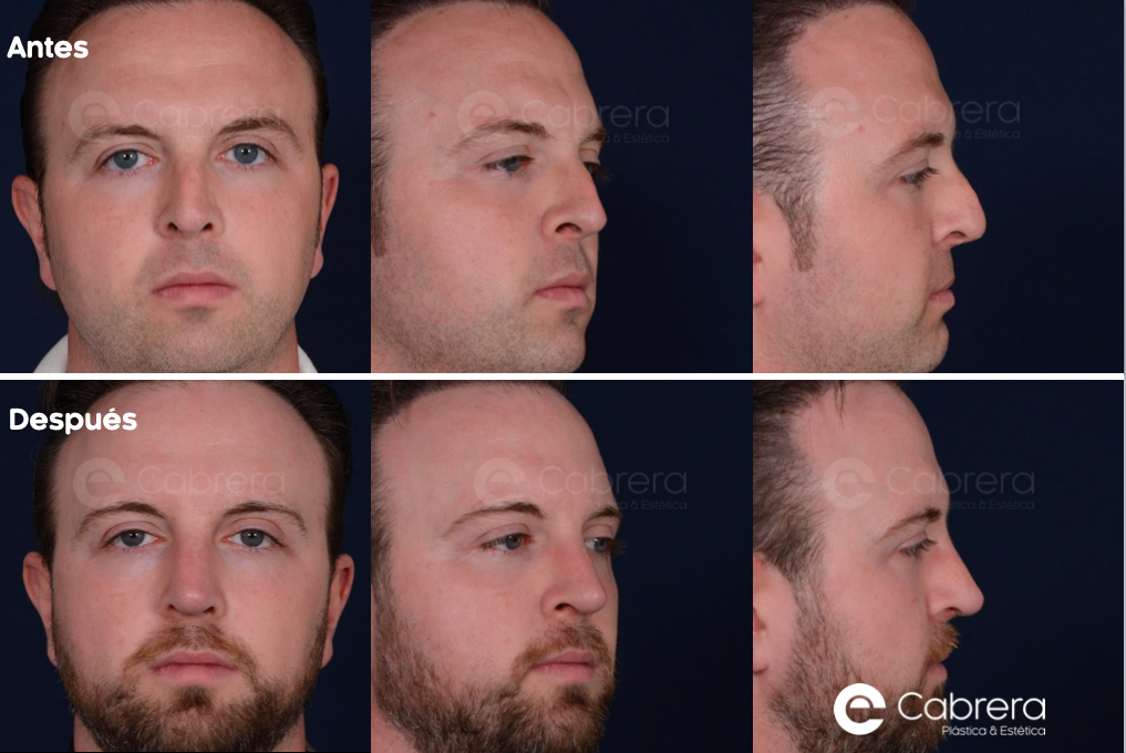 2485C Antes y después en rinoplastia