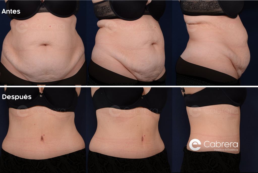 2513C Antes y después en abdominoplastia