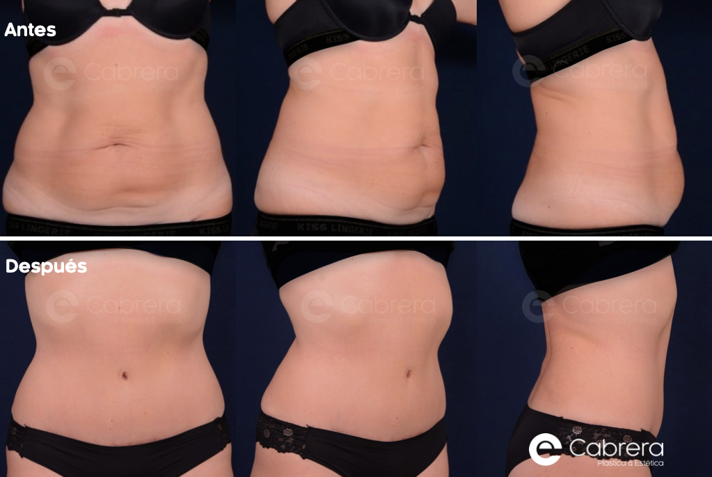 3229CASO Antes y después en abdominoplastia