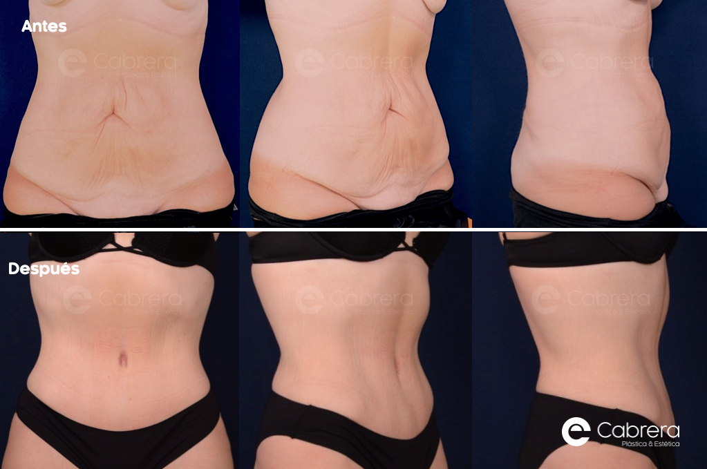 4461-CASO-70-1 Antes y después en abdominoplastia