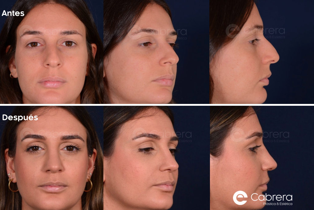 6187C Antes y después en rinoplastia