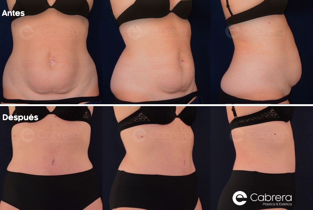 7094CASO-1 Antes y después en abdominoplastia