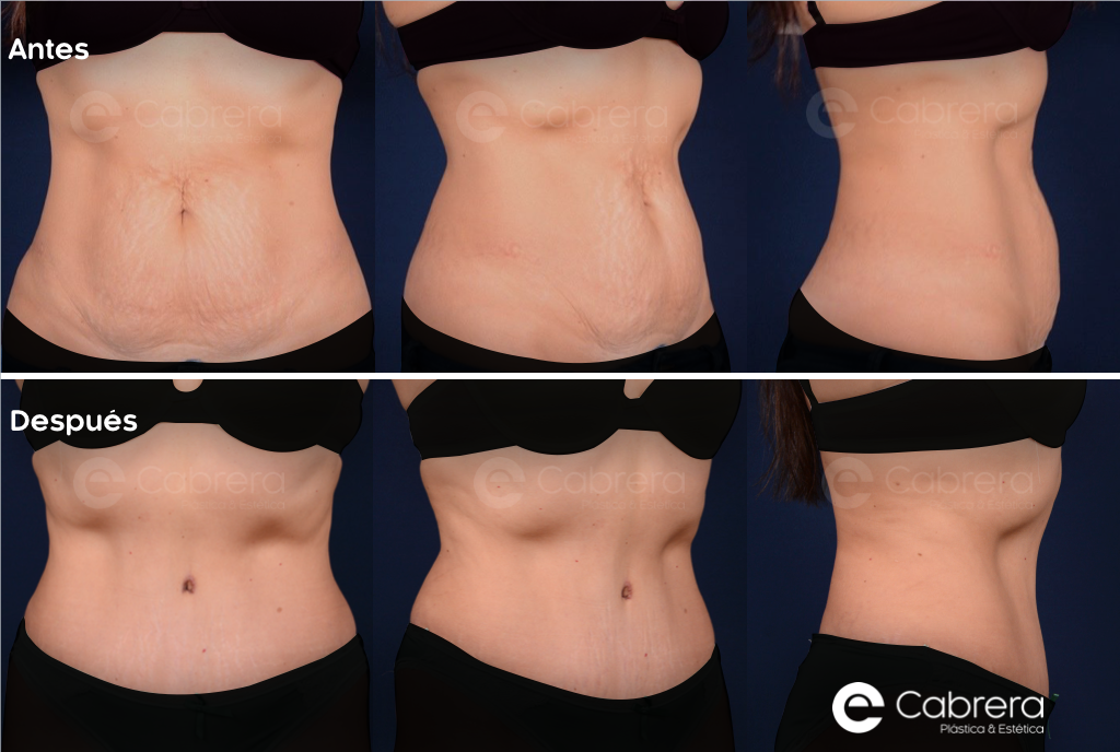 7201C Antes y después en abdominoplastia