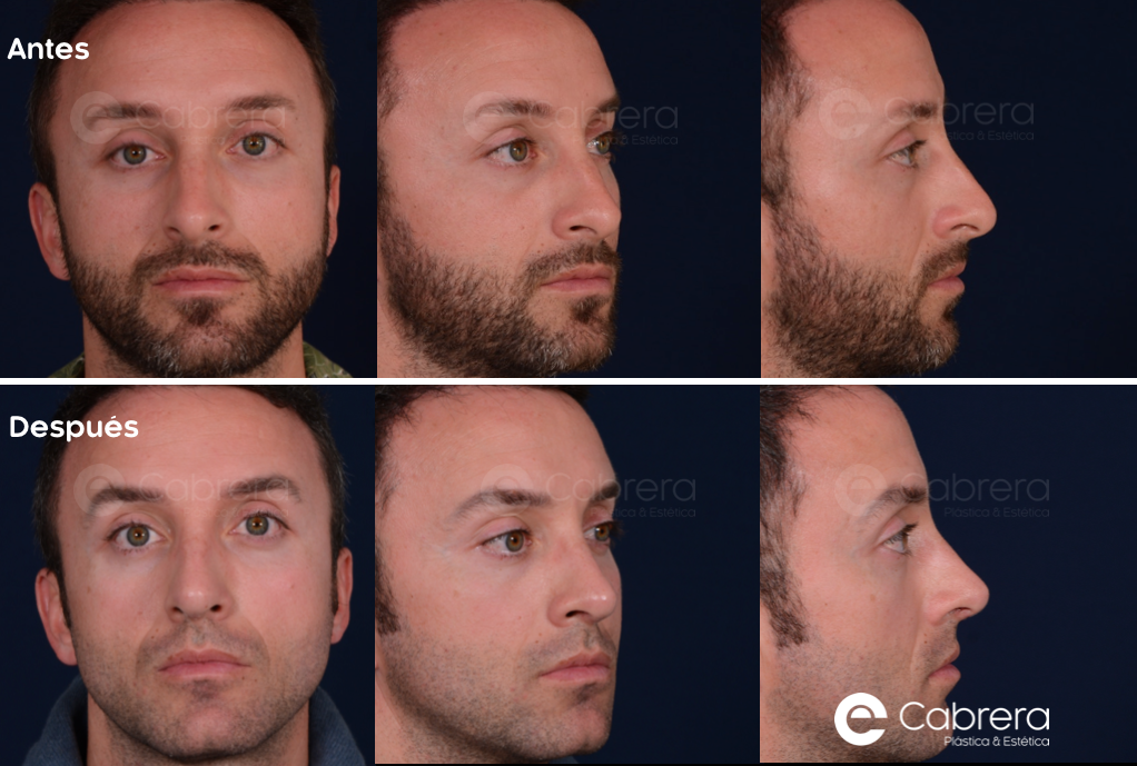 7239C Antes y después en rinoplastia