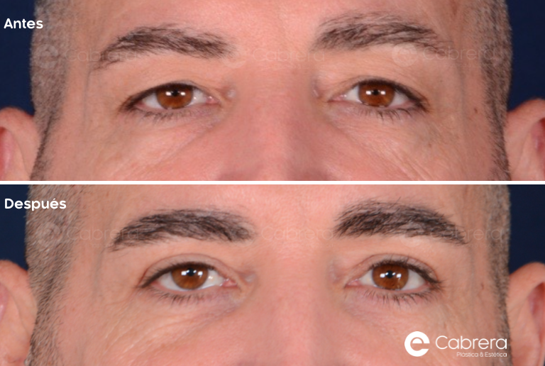 8048C Antes y después en blefaroplastia