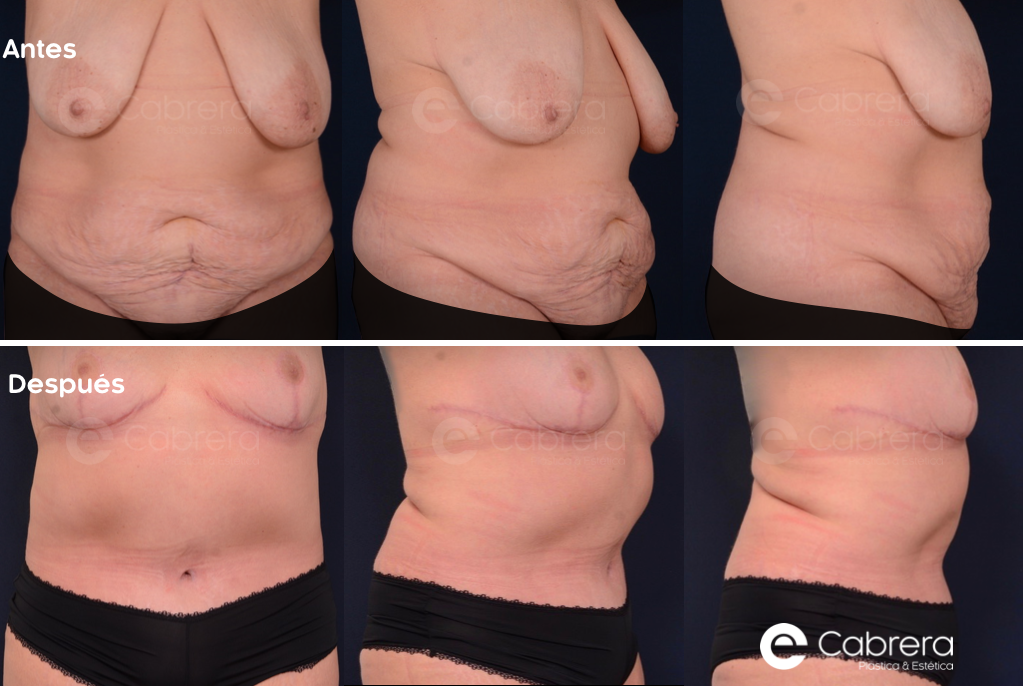 8190C Antes y después en abdominoplastia