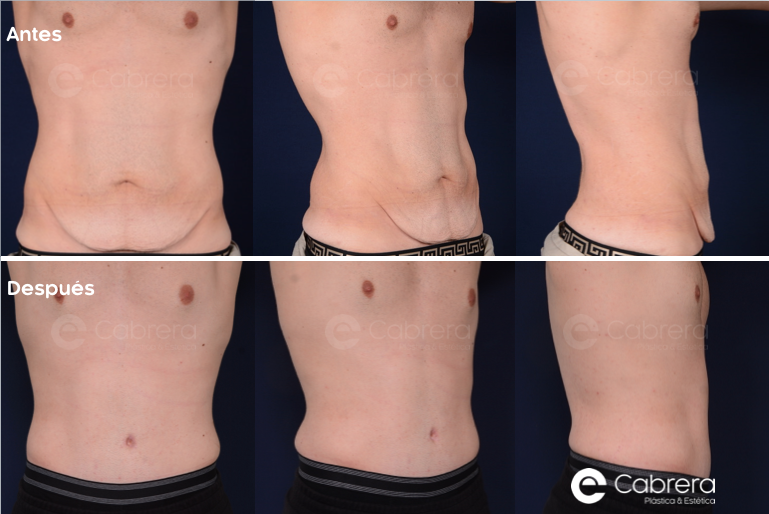 8325C Antes y después en abdominoplastia