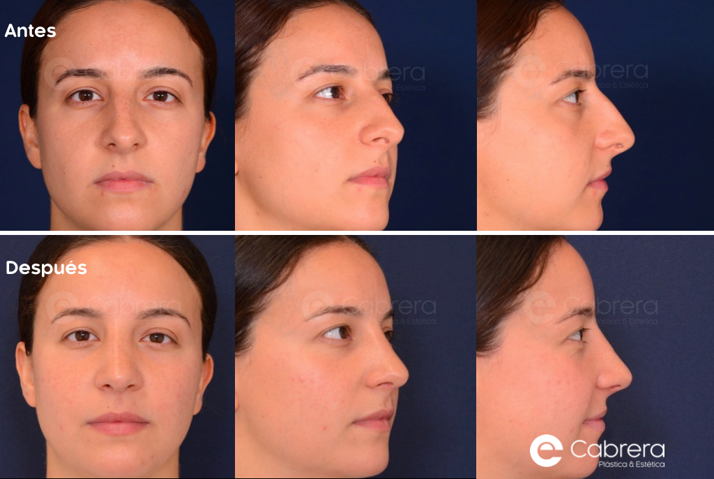 8661C Antes y después en rinoplastia
