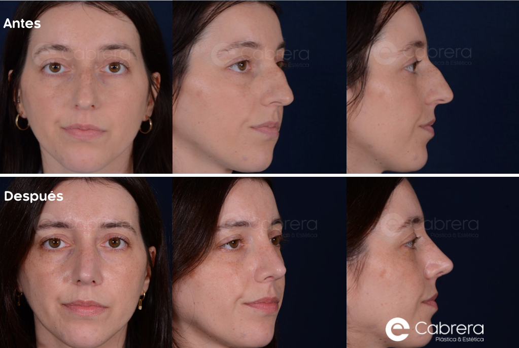 8841C Antes y después en rinoplastia