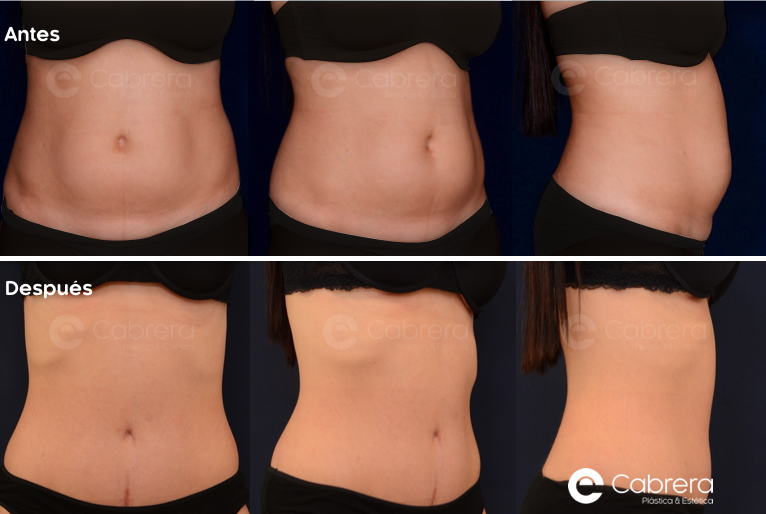 9040C Antes y después en abdominoplastia