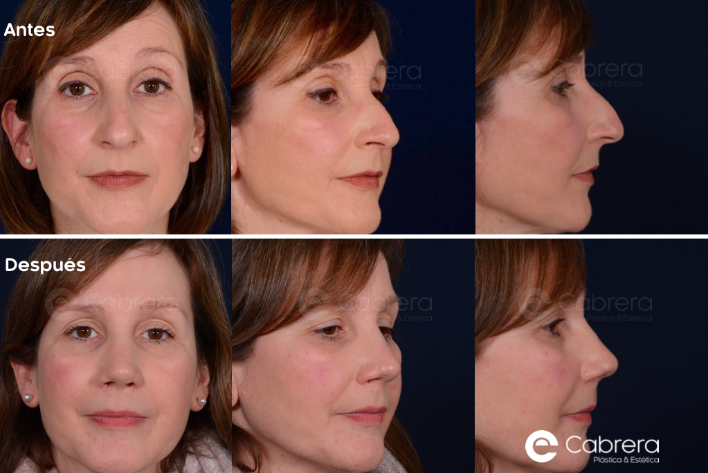 9041C Antes y después en rinoplastia