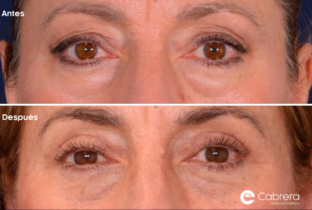 9073C Antes y después en blefaroplastia