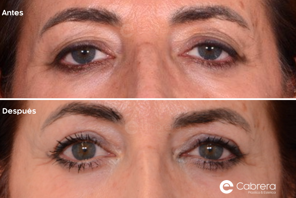9183C-1 Antes y después en blefaroplastia