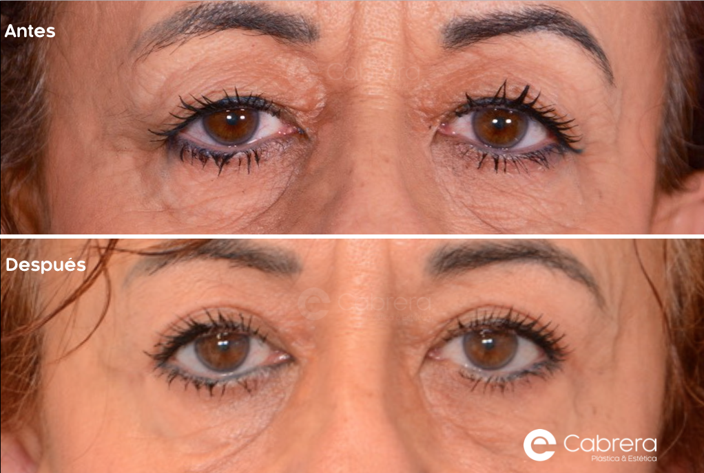 9199C Antes y después en blefaroplastia