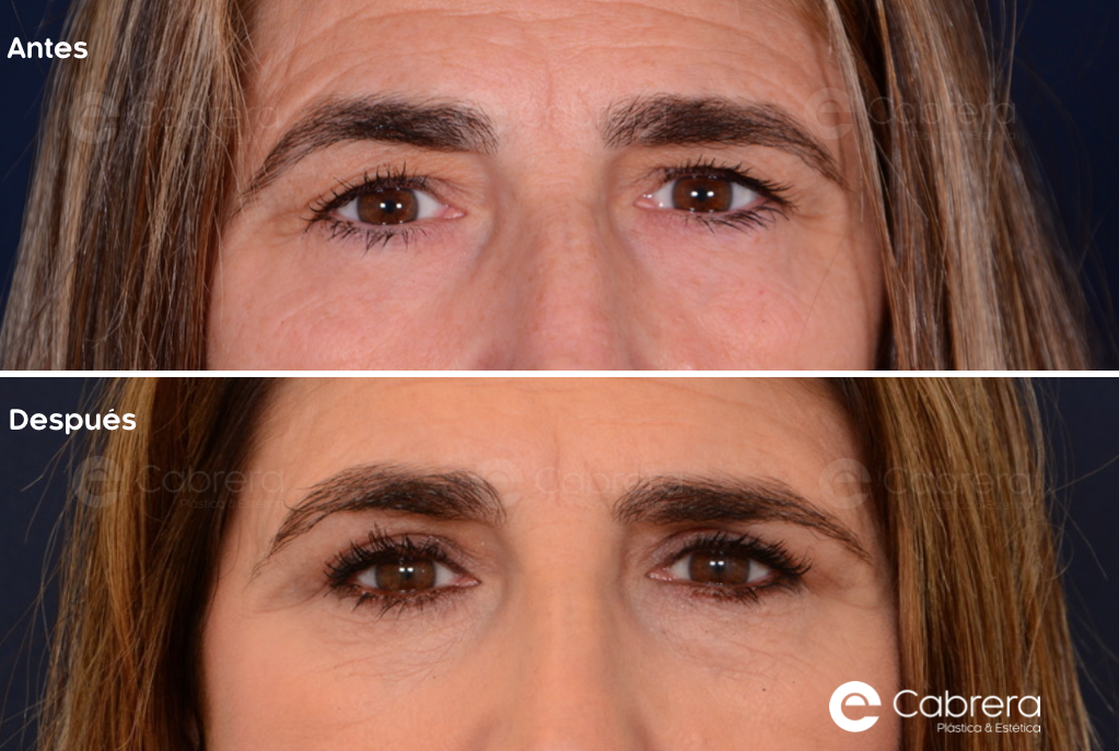 9212CC Antes y después en blefaroplastia
