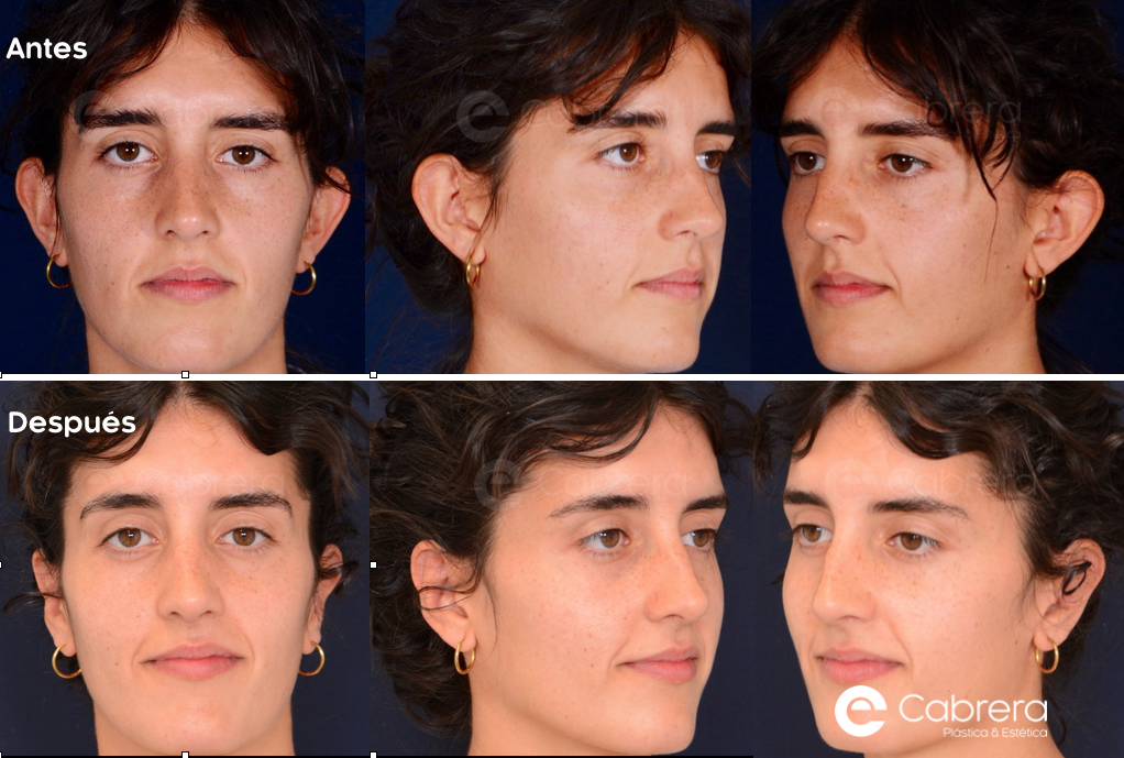 9228C Antes y después en otoplastia