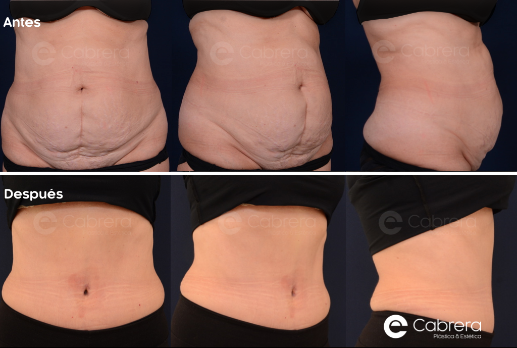 9262C Antes y después en abdominoplastia