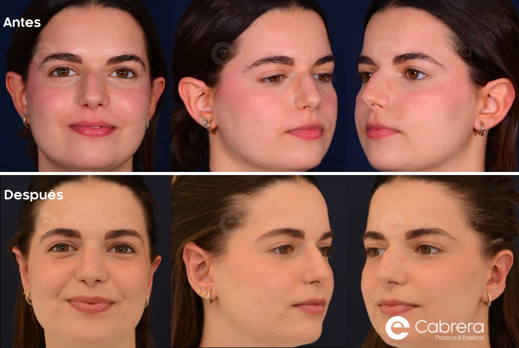 9281C Antes y después en otoplastia