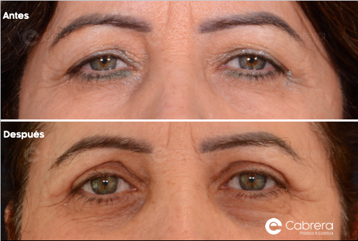 9391C Antes y después en blefaroplastia