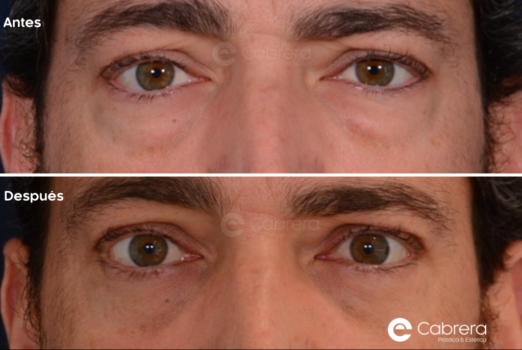 9393C Antes y después en blefaroplastia