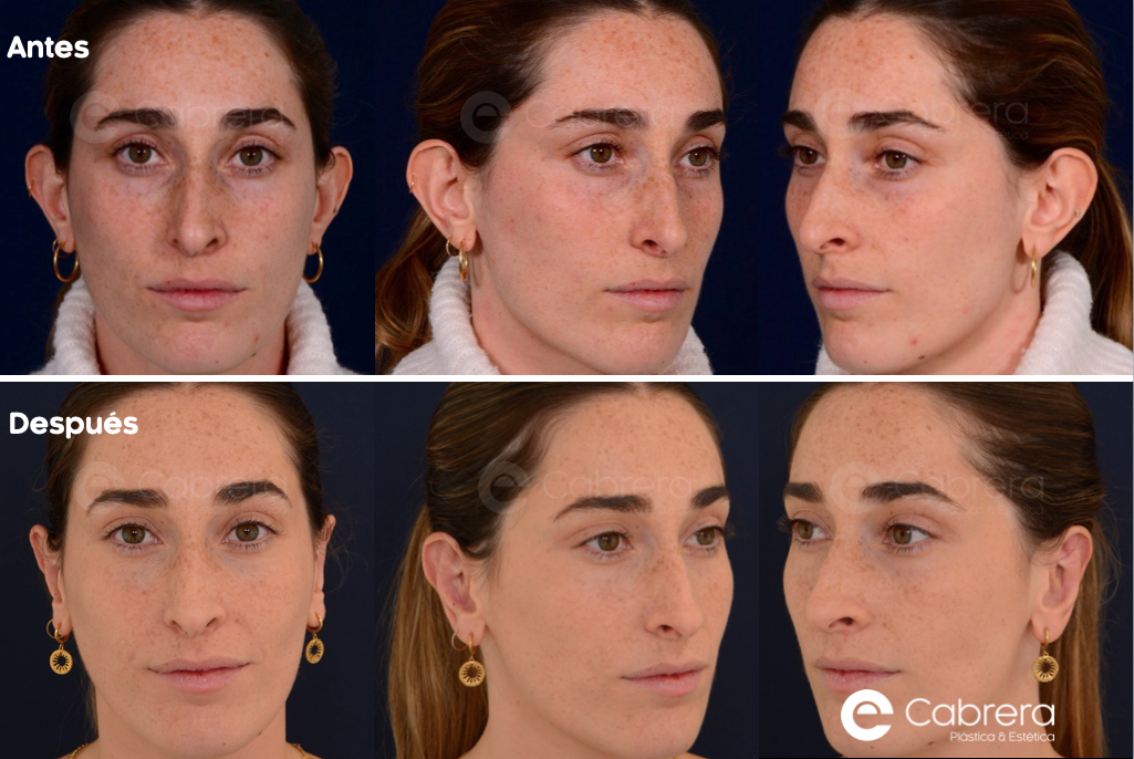 9488C Antes y después en otoplastia
