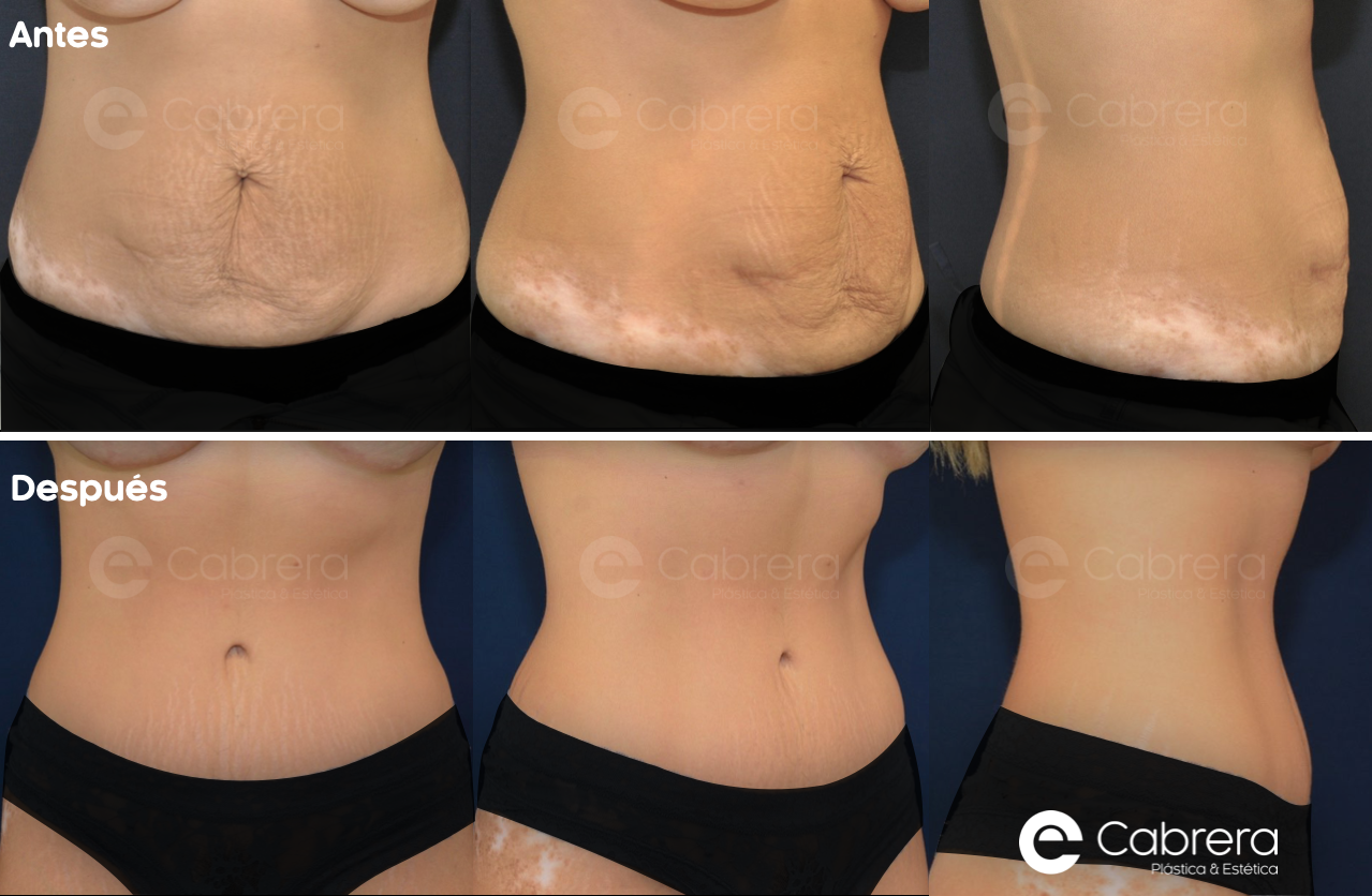 CASO14 Antes y después en abdominoplastia