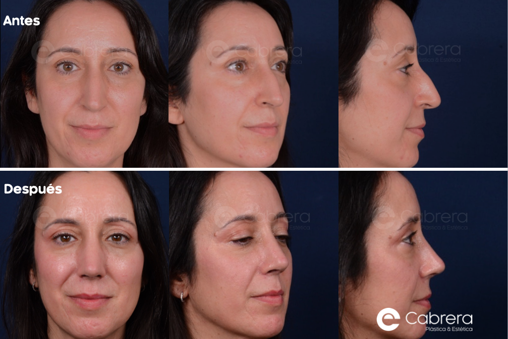 CASO20C Antes y después en rinoplastia
