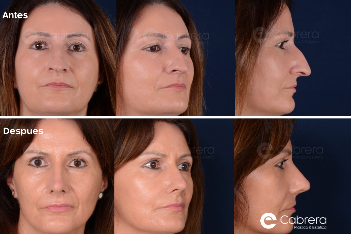 CASO23CC Antes y después en rinoplastia