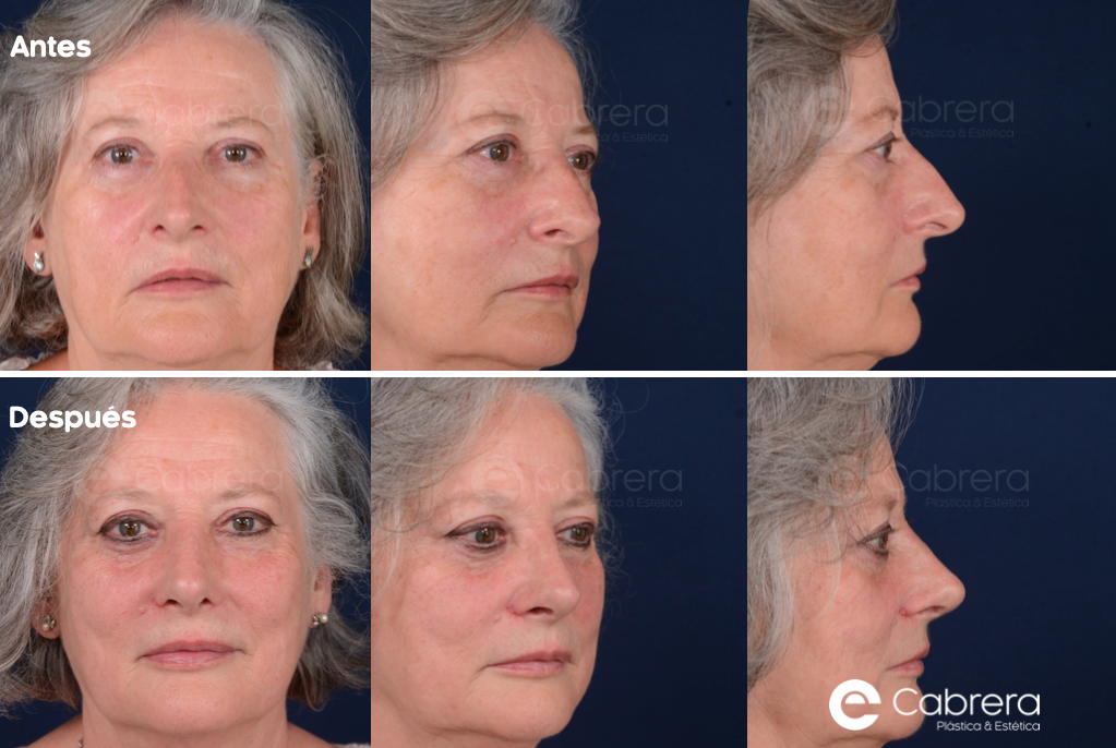CASO24 Antes y después en rinoplastia