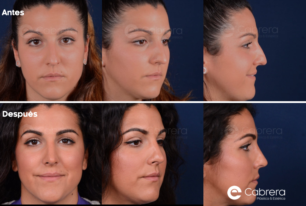 CASO25 Antes y después en rinoplastia