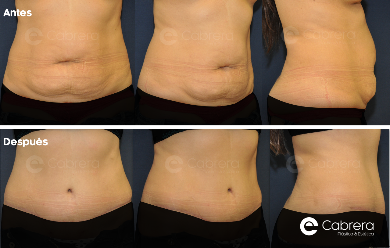 CASO38C-1 Antes y después en abdominoplastia