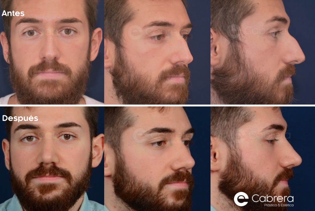 CASO41C Antes y después en rinoplastia