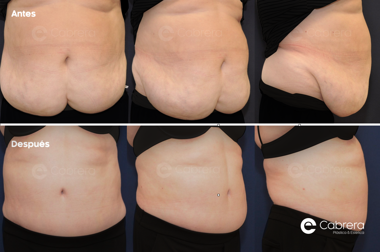 CASO42C Antes y después en abdominoplastia