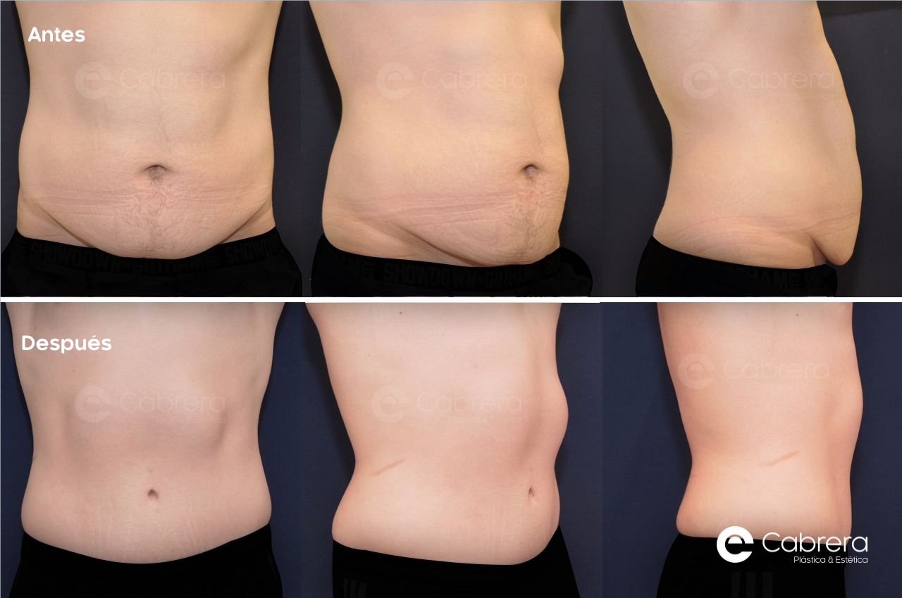 CASO48C Antes y después en abdominoplastia
