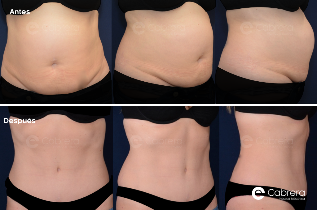 CASO49C Antes y después en abdominoplastia