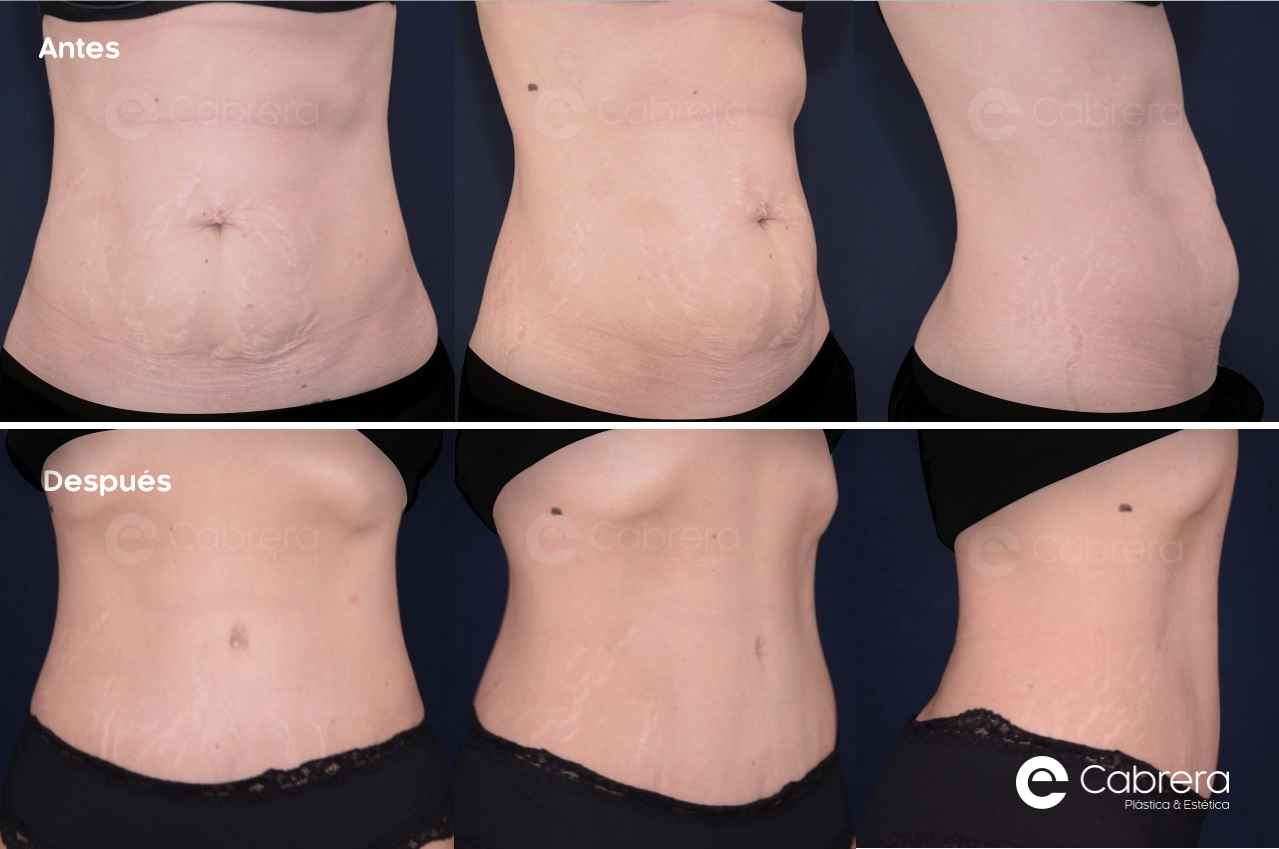 CASO50BIS Antes y después en abdominoplastia