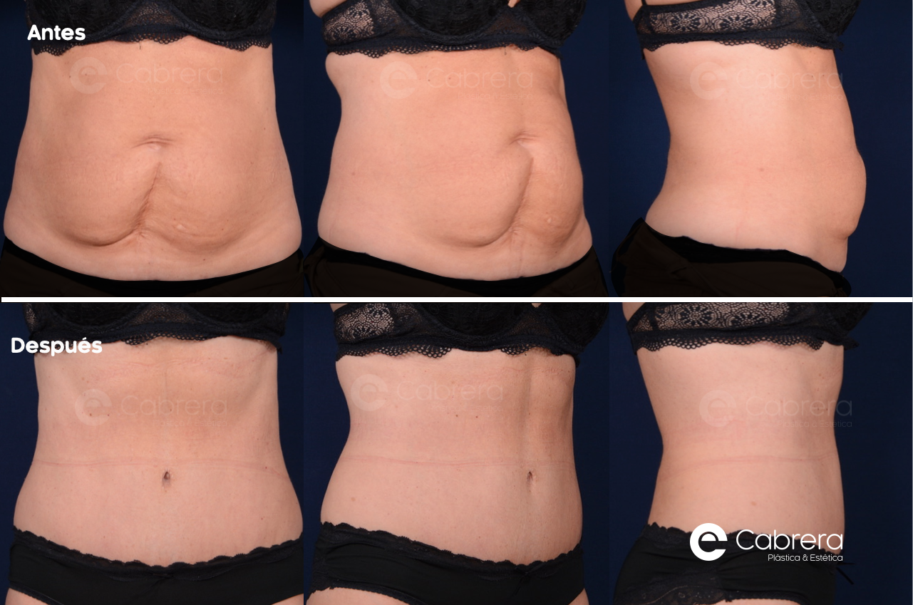 CASO54C Antes y después en abdominoplastia
