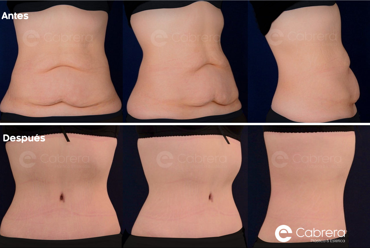 CASO57CC-1 Antes y después en abdominoplastia