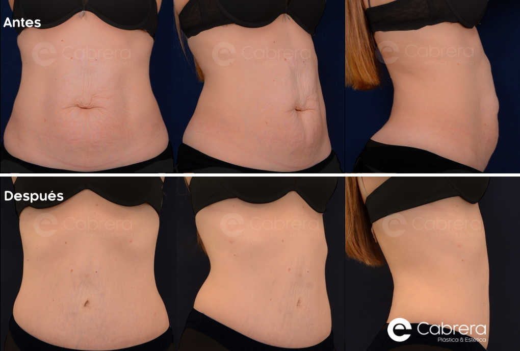 Caso-58C Antes y después en abdominoplastia
