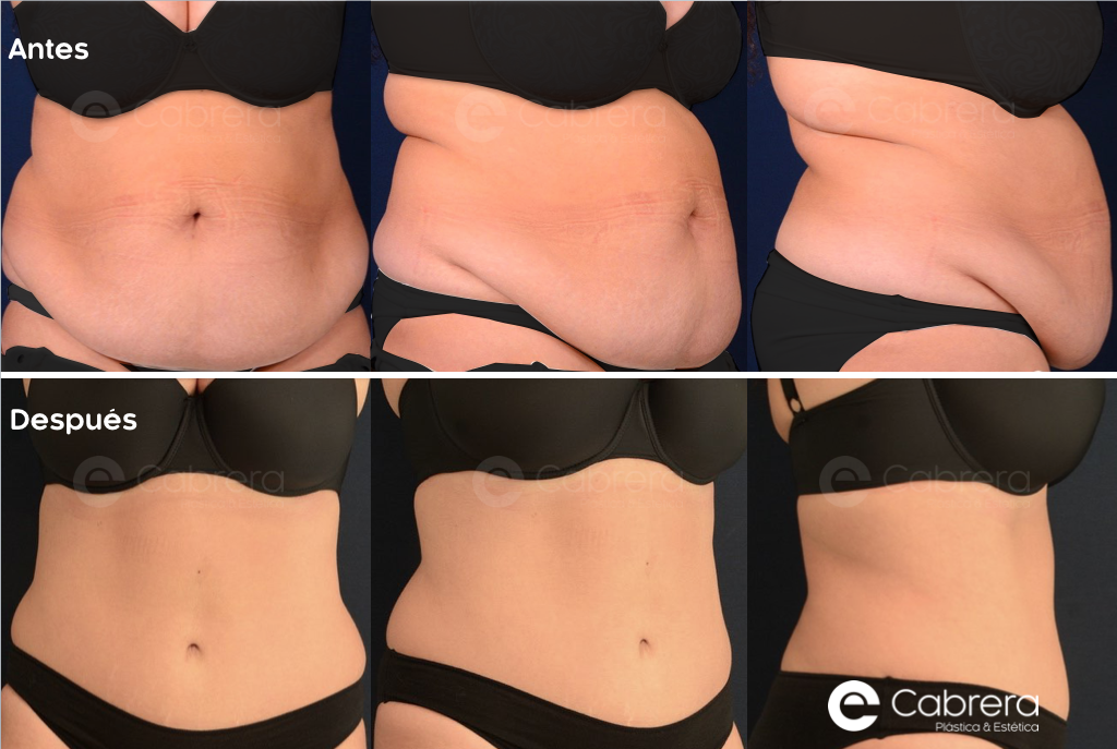 Caso55C Antes y después en abdominoplastia