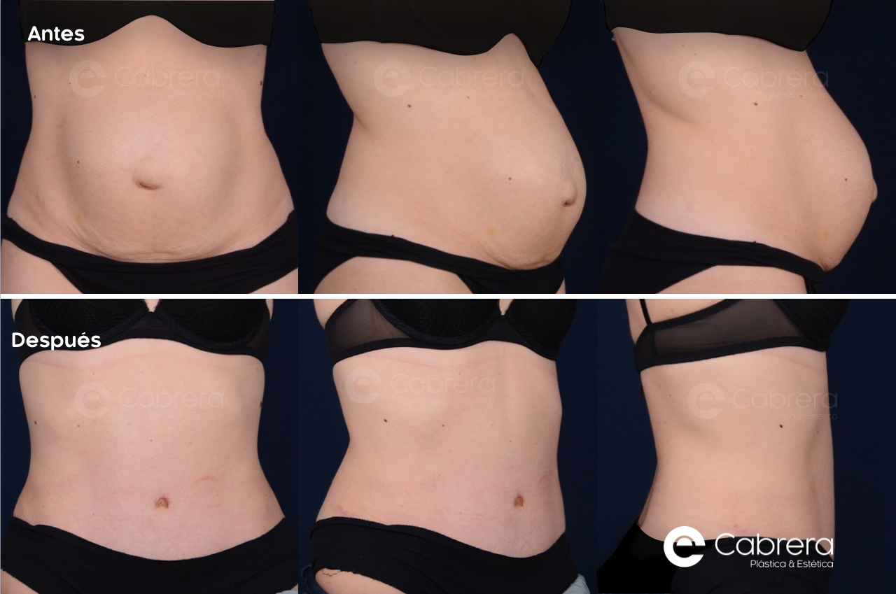 DIAPO71C Antes y después en abdominoplastia
